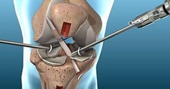 Arthroscopic Knee Ligament Repair