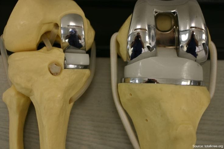 Partial Knee Replacement